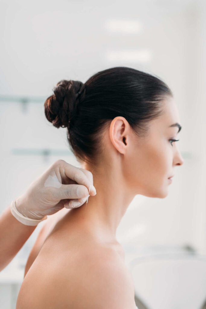 acupuncture for headaches