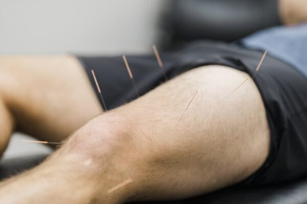 Acupuncture Burlington
