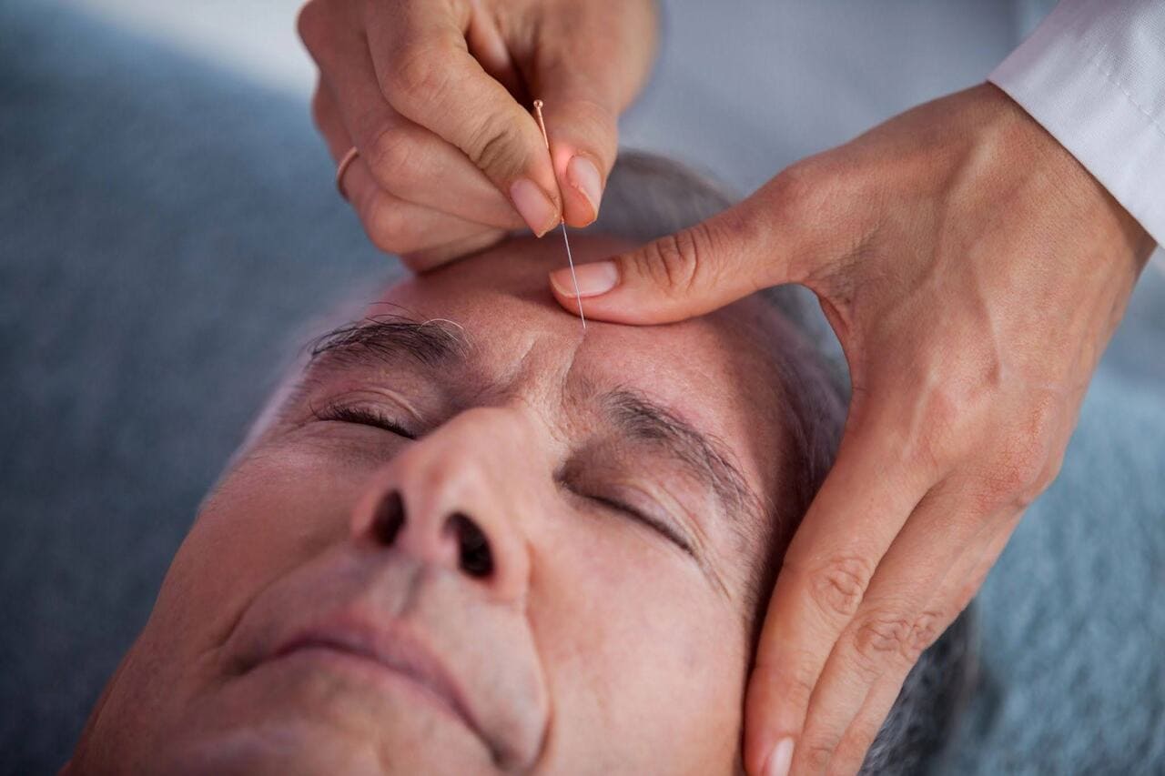acupuncture for headaches